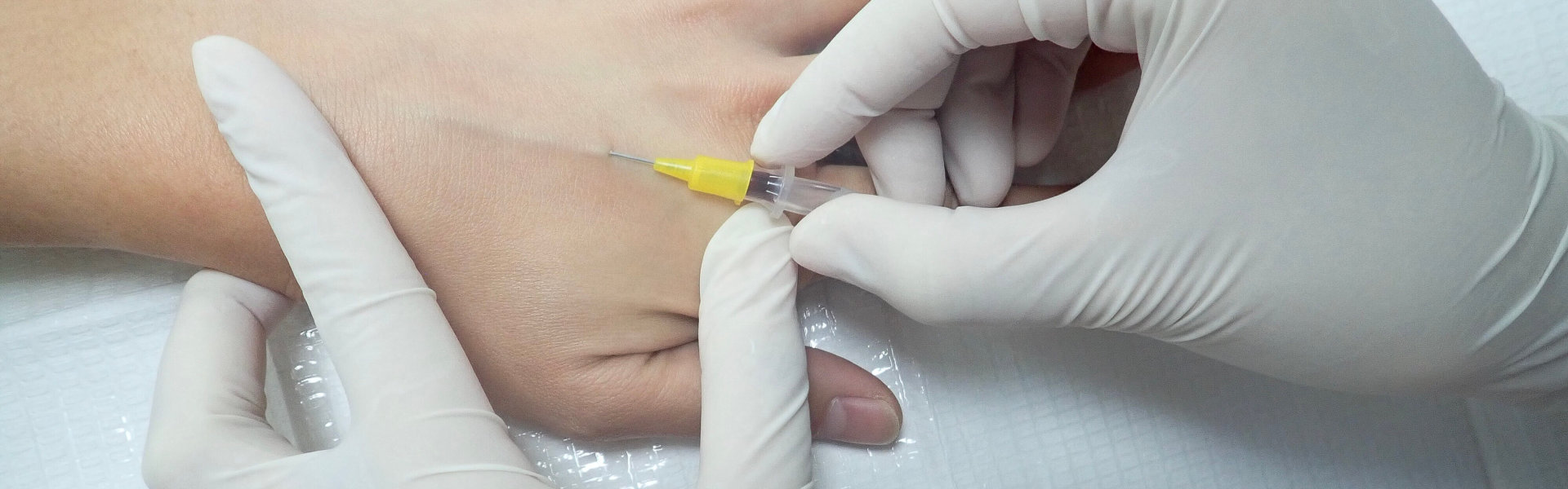 catheter inserted on the patient's arm for IV infusion in a hospital